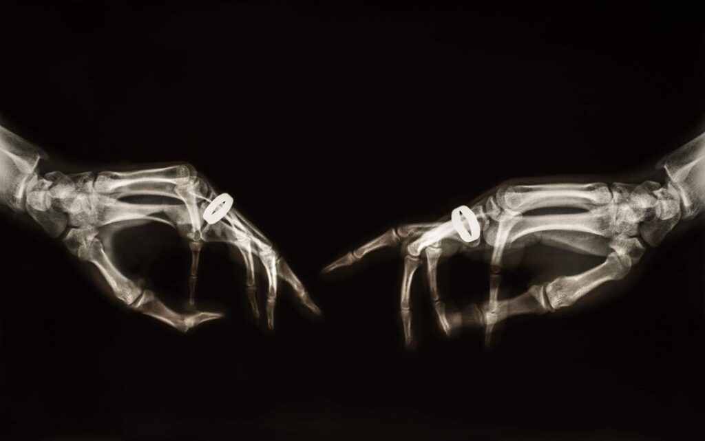 X-ray-style image of two hands with wedding rings